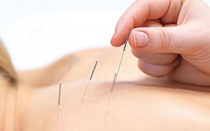 Châm cứu làm giảm đau cho bệnh nhân ung thư vú